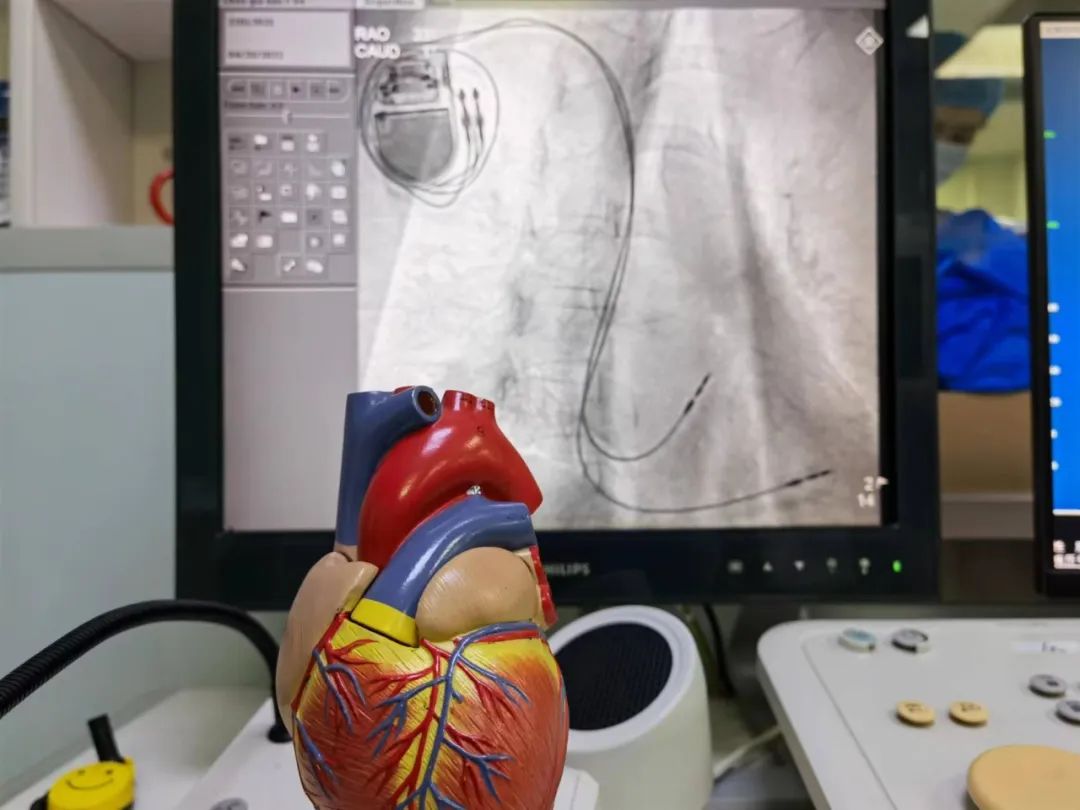 藺雪峰介紹,起搏器植入後,能夠恢復心臟正常節律,改善全身血液供應